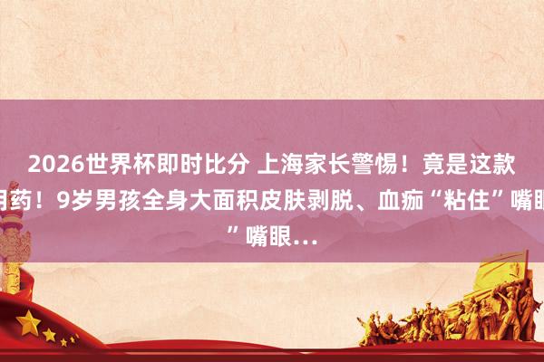 2026世界杯即时比分 上海家长警惕!竟是这款常用药!9岁男孩全身大面积皮肤剥脱、血痂“粘住”嘴眼…